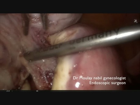 Emergency Hemostatic Laparoscopic Myomectomy
