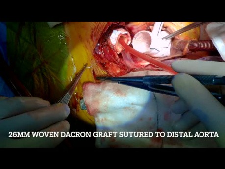 Repair of Acute Type A Aortic Dissection