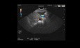 Endoscopic Ultrasound of Common Bile Duct Stone With Normal Bile Duct Diameter 