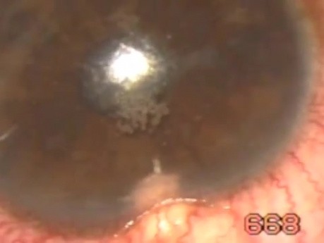 Microtrack filtration -eye surgery