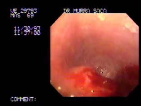 Squamous Cell Carcinoma of the Cardias (1 of 2 )