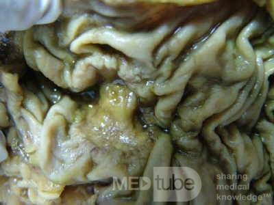 Ascending Colon Cancer (7 of 9)
