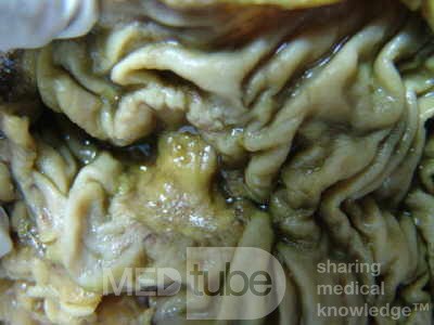 Ascending Colon Cancer (7 of 9)