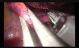 Uniportal VATS Lower Posterior Anatomic Segmentectomy (S10)