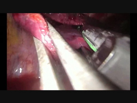 Uniportal VATS Lower Posterior Anatomic Segmentectomy (S10)