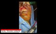 Facial Trauma Surgery