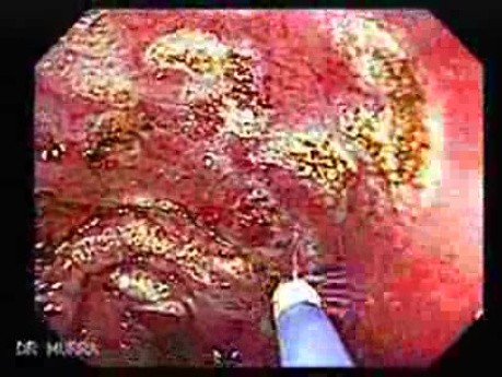 Post-Radiation Colitis (7 of 13)