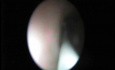 Retrograde Endopyelotomy - Part 1