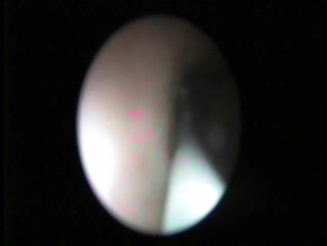 Retrograde Endopyelotomy - Part 1