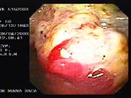 Extensive Neoplasia (3 of 4)