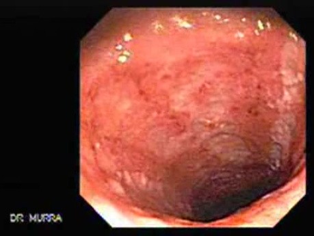 Endoscopy Of Ulcerative Colitis (2 of 3)