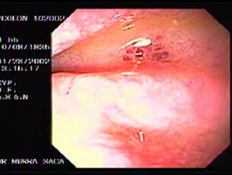 Cryptosporidiosis of Colon (2 of 3)