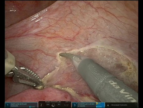 Robot-assisted Surgery for the Treatment of Endometriosis