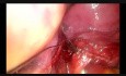 Subxiphoid Uniportal Vats Middle Lobectomy