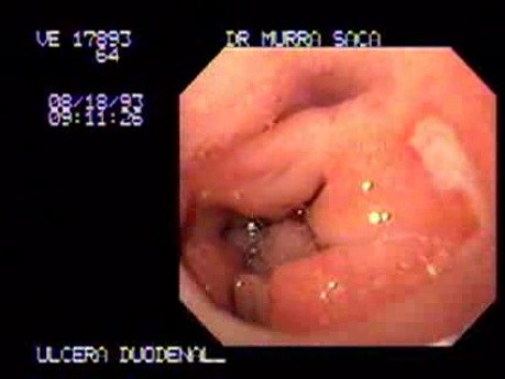 Duodenal Ulcer