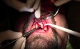 Extraction-Bone Grafting-CCL Surgery