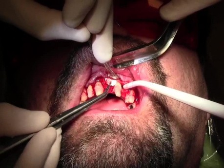 Extraction-Bone Grafting-CCL Surgery