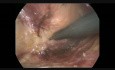 Laparoscopic Ultra Low Anterior Resection + TME