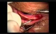 Surgery of Entropion-Trichiasis of the Upper Lid