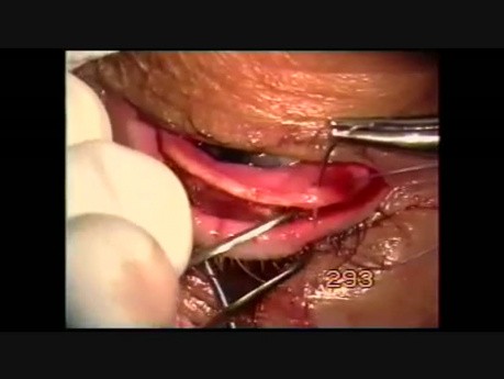 Surgery of Entropion-Trichiasis of the Upper Lid
