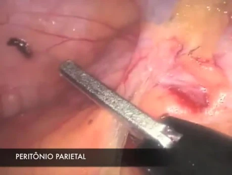 Laparoscopic Proctocolectomy for Familiar Adenomatous Polyposis (FAP) Treatment