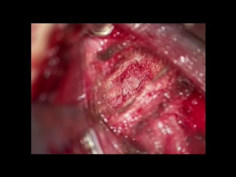 Dislocation fracture of the cervical spine
