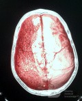 Acute Spontaneous Subdural Hemorrhage in the Subdural Space