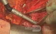 Atrial Resection for T4 Non-small Cell Lung Cancer with Left Atrium Involvement