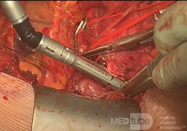 Atrial Resection for T4 Non-small Cell Lung Cancer with Left Atrium Involvement