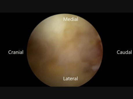 Biportal Endoscopic Transforaminal Interbody Fusion (BE-TLIF), Advanced BESS Technique