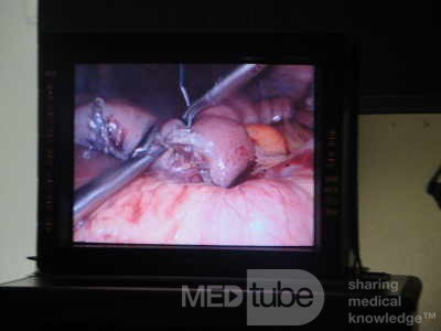 Gastric Ulcerated Adenocarcinoma of the Pre-pyloric Antrum (10 of 28)