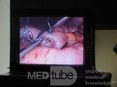 Gastric Ulcerated Adenocarcinoma of the Pre-pyloric Antrum (10 of 28)