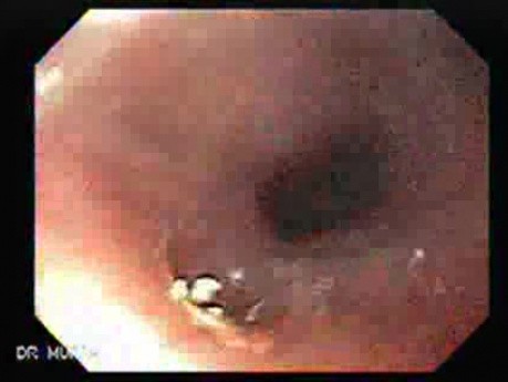Gastric Cicatrization With Pylorus Stenosis (22 of 23)