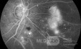 Proliferative Diabetic Retinopathy in Fluorescein Angiography