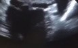 Huge Thrombus in Left Atrium