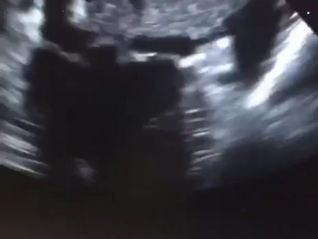 Huge Thrombus in Left Atrium