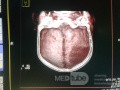 Acute Spontaneous Subdural Hemorrhage in the Subdural Space