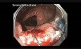 Transverse colon - EMR Of A Large Colon Tumor 