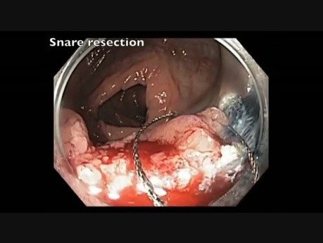 Transverse colon - EMR Of A Large Colon Tumor 
