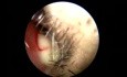 Nasal Septal Abscess - Unusual Presentation