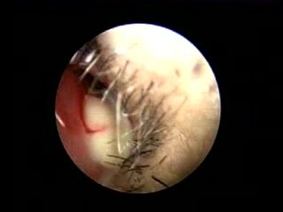 Nasal Septal Abscess - Unusual Presentation