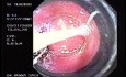 Banding of esophageal varices (3 of 17)