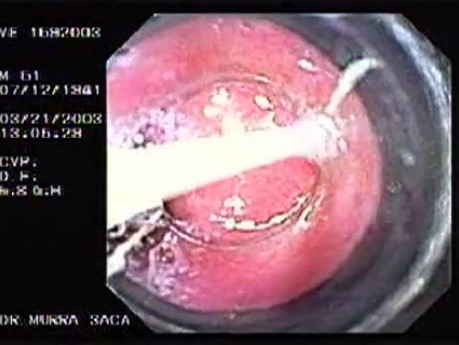 Banding of esophageal varices (3 of 17)