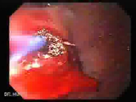 Upper Gastrointestinal Bleeding (3 of 3)