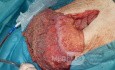 Greater Omentum Necrosis