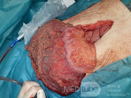 Greater Omentum Necrosis