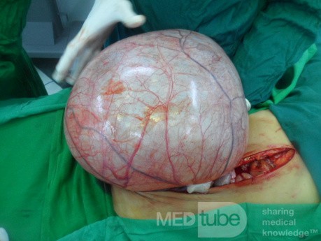 Left ovarian cyst