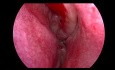 Antrochoanal Polyp