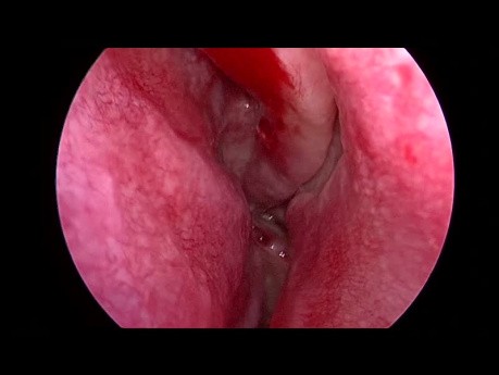 Antrochoanal Polyp