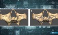 How Subperiosteal Dental Implants are Made